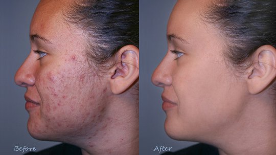 What Foods and Herbal Remedies Help Alleviate Acne? What Foods and Herbal Remedies Help Alleviate Acne?
