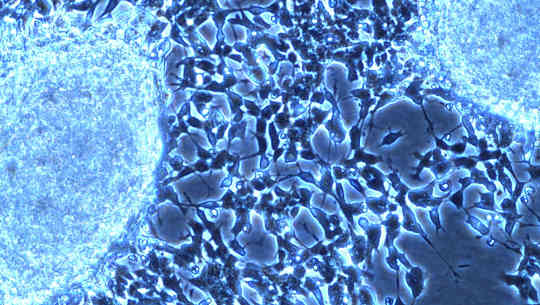 One Gene That Links Both Autism And A Tumor Disorder One Gene That Links Both Autism And A Tumor Disorder