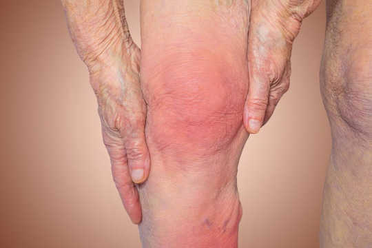 Knee Arthroscopy Is One Of The Most Common And Why The Least Effective Surgeries