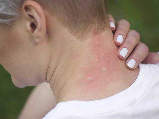 Tropical Diseases Will Ride Mosquitoes Really Far North Tropical Diseases Will Ride Mosquitoes Really Far North