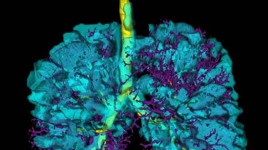 Vaping: As An Imaging Scientist I Fear The Deadly Impact On People’s Lungs Vaping: As An Imaging Scientist I Fear The Deadly Impact On People’s Lungs