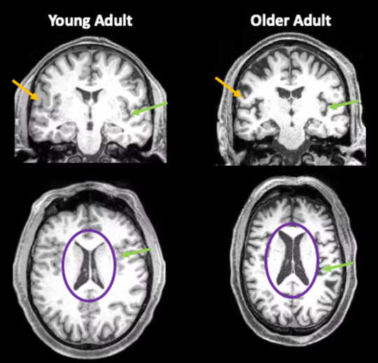Even Mild Cases Of Covid-19 Can Leave A Mark On The Brain covid linked to brain shrinkage