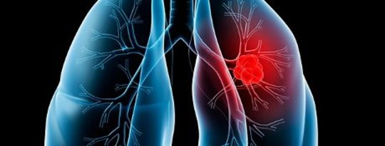 Lung Cancer Lung Cancer